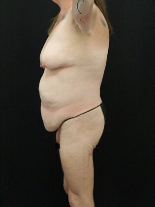 Tummy Tuck: Case 55 - Before