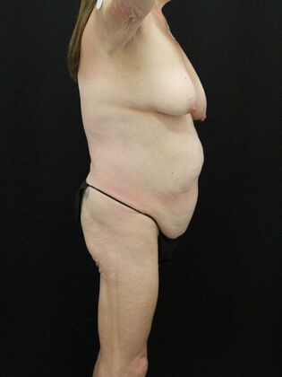 Tummy Tuck: Case 55 - Before