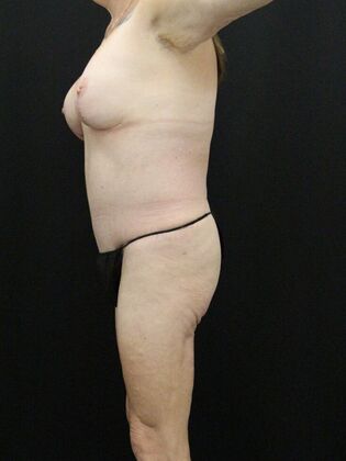 Tummy Tuck: Case 55 - After