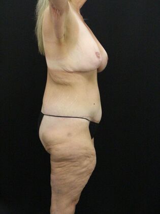 Tummy Tuck: Case 56 - After