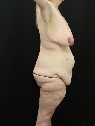 Tummy Tuck: Case 56 - Before