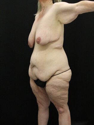 Tummy Tuck: Case 56 - Before