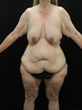 Tummy Tuck Case 56 - Before