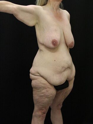 Tummy Tuck: Case 56 - Before