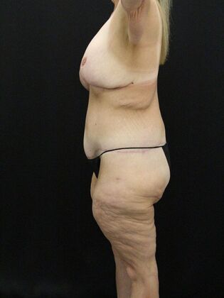 Tummy Tuck: Case 56 - After