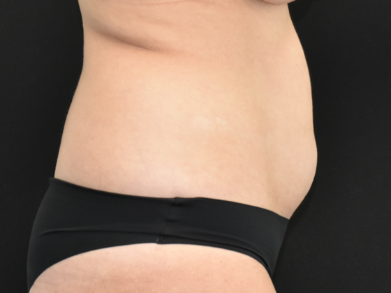 Abdominoplasty: Case 17 - Before