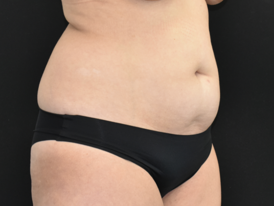 Abdominoplasty: Case 17 - Before