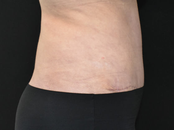Abdominoplasty: Case 17 - After