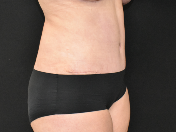 Abdominoplasty: Case 17 - After