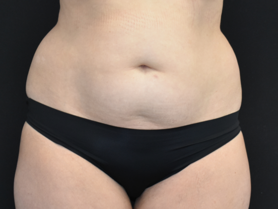 Abdominoplasty Case 17 - Before