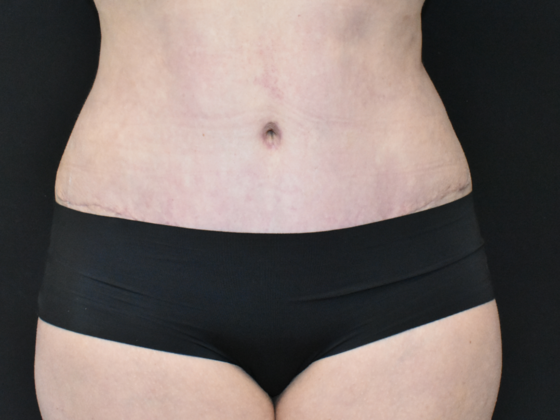 Abdominoplasty Case 17 - After