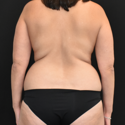 Abdominoplasty: Case 17 - Before