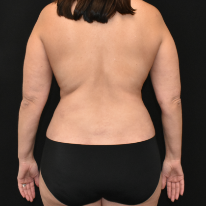 Abdominoplasty: Case 17 - After