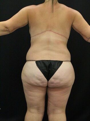 Body Lift Case 11 - After