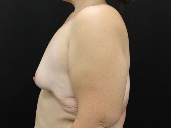 Breast Lift/Breast Lift Augmentation: Case 58 - Before