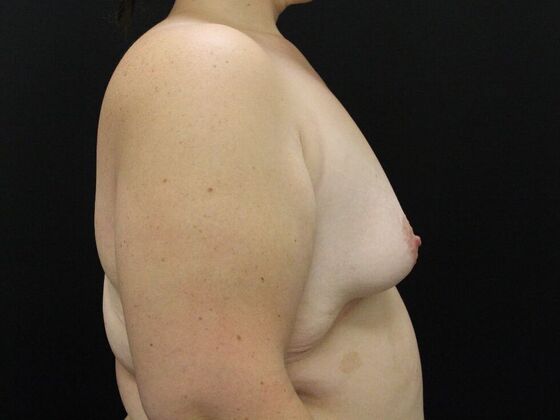 Breast Lift/Breast Lift Augmentation: Case 58 - Before