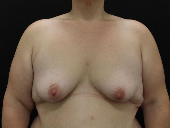 Breast Lift/Breast Lift Augmentation Case 58 - Before