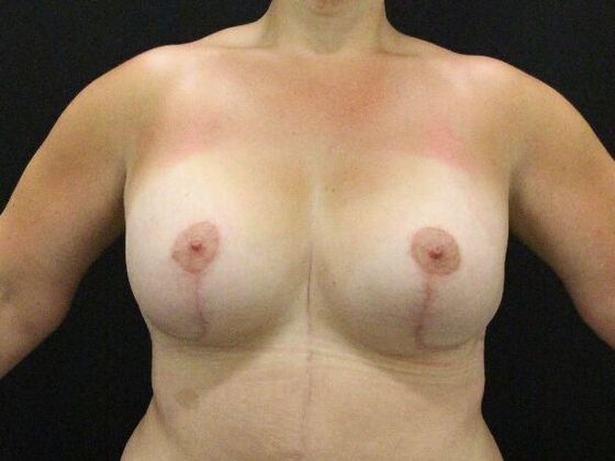 Breast Lift/Breast Lift Augmentation Case 58 - After