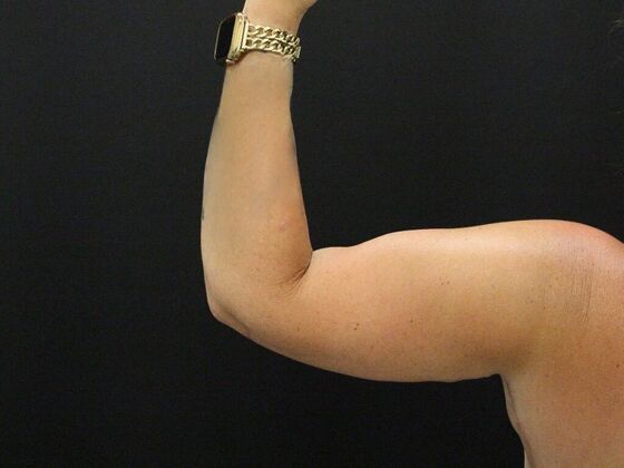 Arm Lift: Case 25 - After