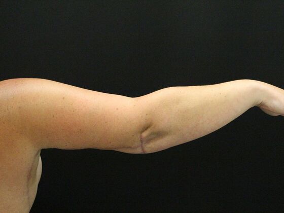 Arm Lift: Case 25 - After