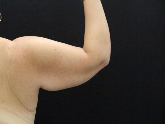 Arm Lift: Case 25 - Before