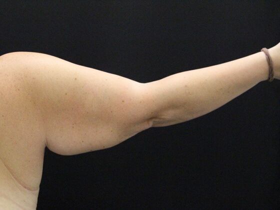 Arm Lift: Case 25 - Before