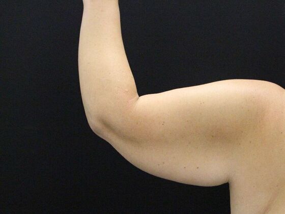 Arm Lift: Case 25 - Before