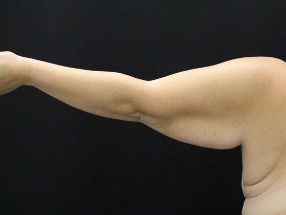 Arm Lift: Case 25 - Before