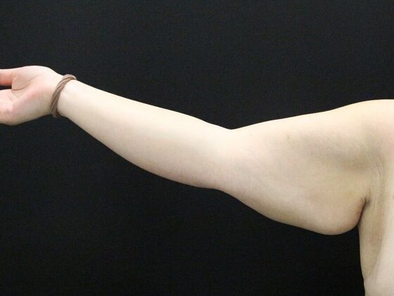 Arm Lift: Case 25 - Before