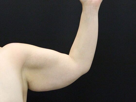 Arm Lift: Case 25 - Before