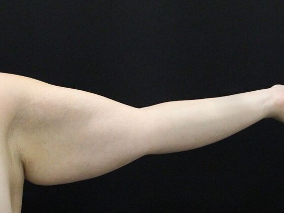 Arm Lift: Case 25 - Before