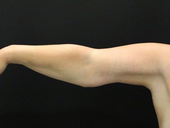 Arm Lift: Case 25 - After