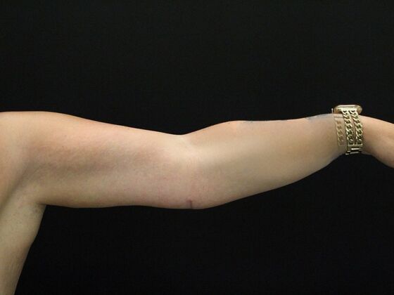 Arm Lift: Case 25 - After