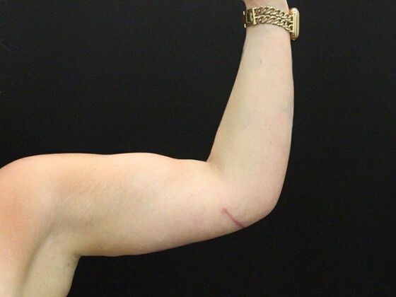 Arm Lift: Case 25 - After