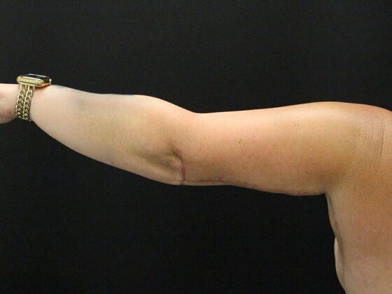 Arm Lift: Case 25 - After