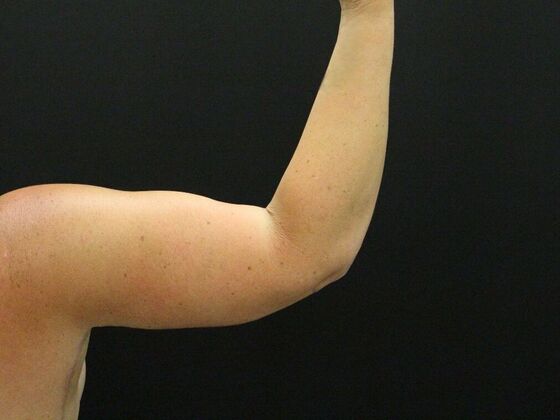 Arm Lift: Case 25 - After