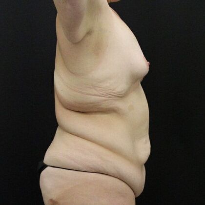 Tummy Tuck: Case 70 - Before