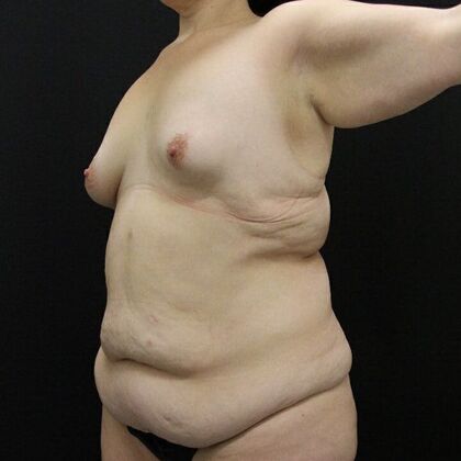 Tummy Tuck Case 70 - Before