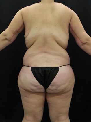 Body Lift Case 11 - Before