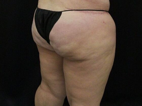 Thigh Lift: Case 8 - Before