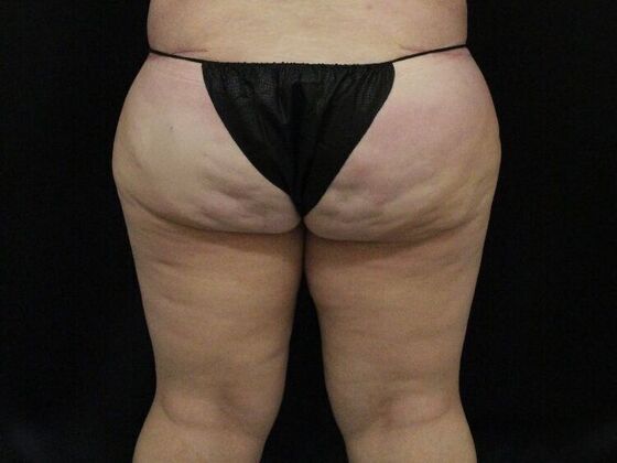 Thigh Lift Case 8 - Before