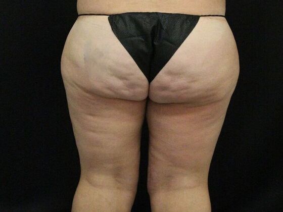 Thigh Lift Case 8 - After