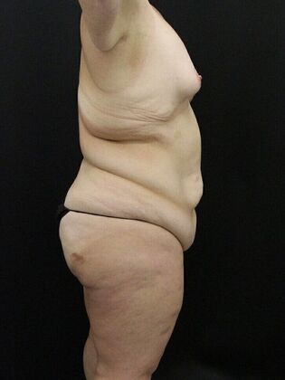 Liposuction: Case 32 - Before