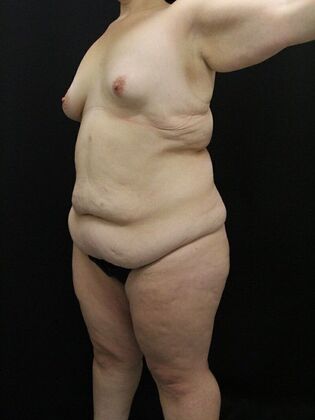 Liposuction: Case 32 - Before