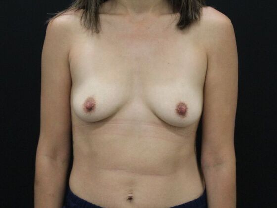 Breast Augmentation: Case 115 - Before