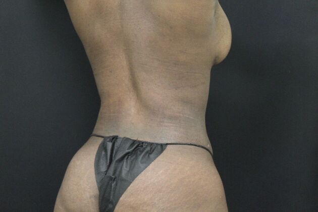 Liposuction: Case 33 - After