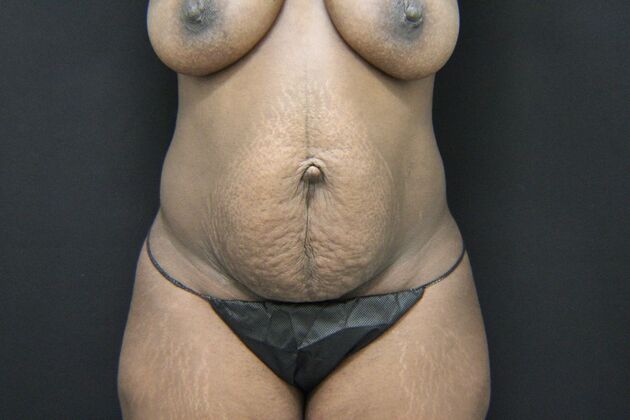 Liposuction Case 33 - Before