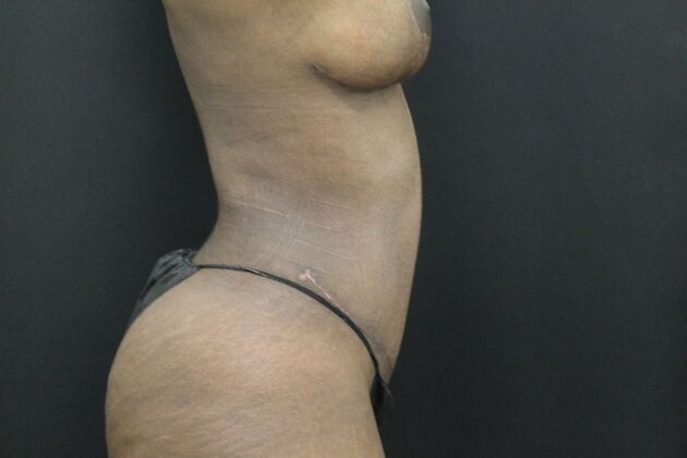 Liposuction: Case 33 - After