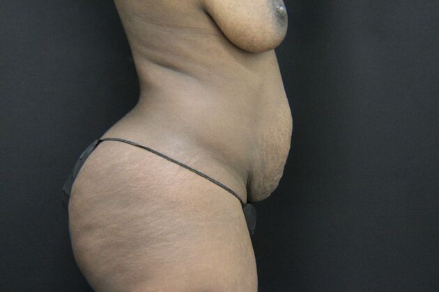 Liposuction: Case 33 - Before