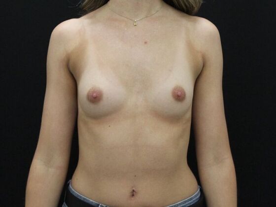 Breast Augmentation Case 100 - Before